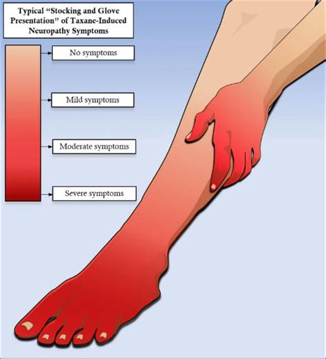 stocking glove syndrome|Small Fiber Neuropathy: Symptoms, Treatment,。